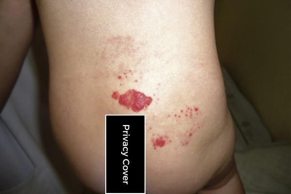 Segmental lumbosacral hemangioma shown in a 2-year-old